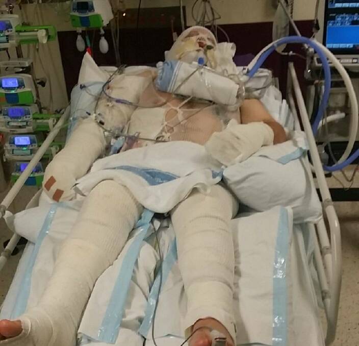 RECOVERING: Stuart Pollard is currently recovering from burns to his face, hands and legs after a gas cylinder explosion on July 1. Almost $20,000 has been raised to help with his medical expenses.