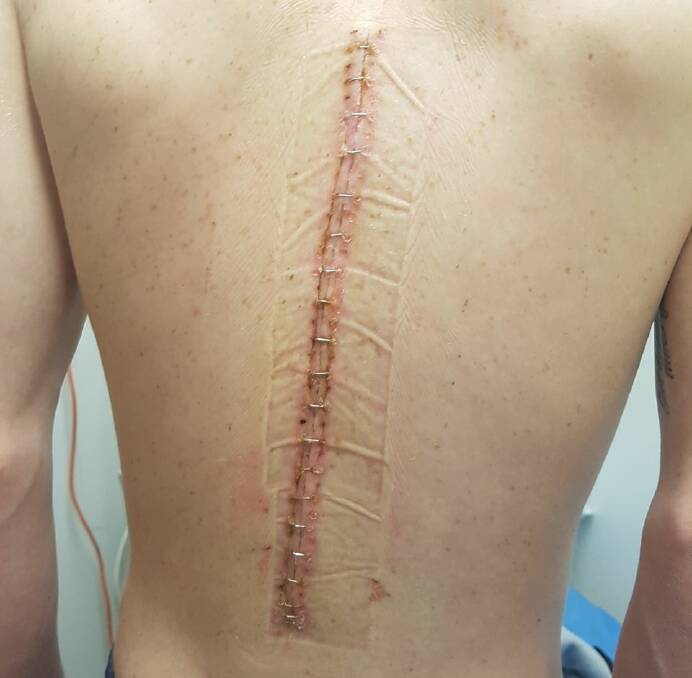 John Kissick's back, post surgery.
