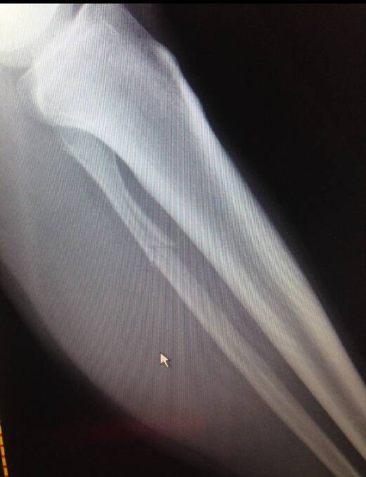 MORE THAN A CORK: The X-ray showing the broken fibula in Andy Carey's left leg.
