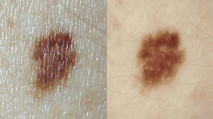 For the first time, melanoma deaths could start to fall