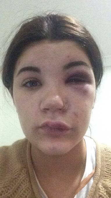Makayla Hopkins-Windle is now recovering from her facial injuries. Picture: supplied