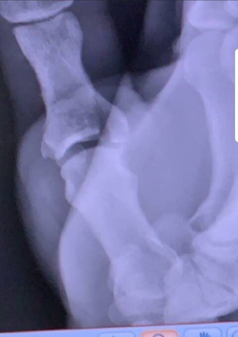 Damage to Newcombe's thumb shown on an X-ray.