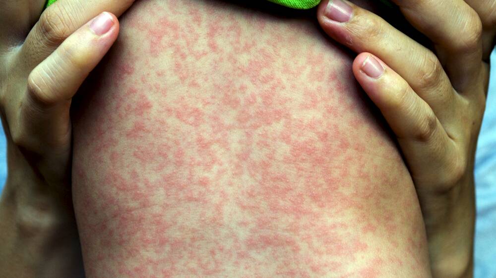 Look out for measles symptoms including a red, spotty, non-itchy rash which usually starts on the head and neck and moves down onto the trunk and limbs.