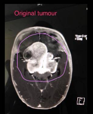 An image showing the original tumour in Patrick Wallace's brain.
