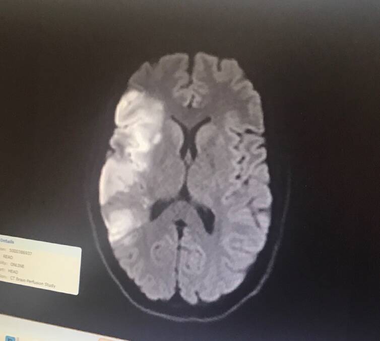 The scan of Helen's brain. The white part shows where no blood was getting to her brain. 