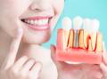 There are many factors to consider before deciding if dental implants or bridges are the most appropriate solution to missing teeth. Picture Shutterstock