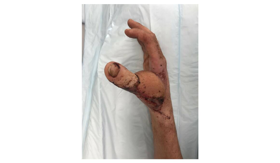 Zac Mitchell's right hand after his big toe was attached to his hand. Photo: SOUTH EASTERN SYDNEY LOCAL HEALTH DISTRICT